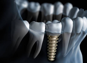 Dental Implants